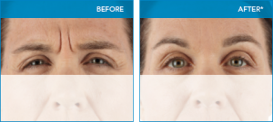 Xeomin before and after